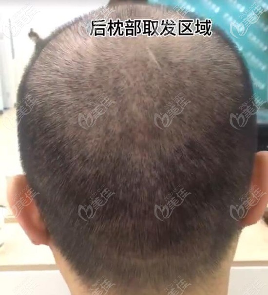 发线后移生姜擦头皮_用生姜蜂蜜可以消除眼袋吗_发际线高用生姜可以吗