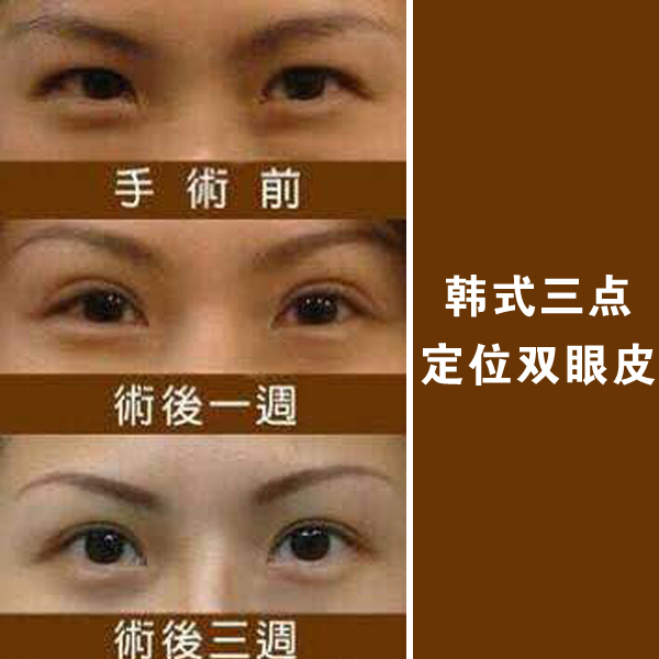 两点定位双眼皮的做法_发根定位烫能保持多久_定位双眼皮能保持几年