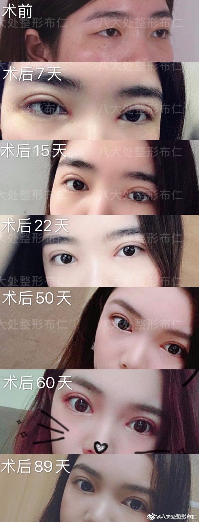 丹东哪家美容院做双眼皮好_去整容院做眉毛哪种眉型好_嘉兴哪里做美容冠好