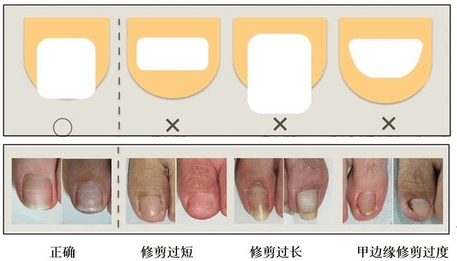 手上长水泡而且指甲里面空了_指甲长到肉里面怎么办_指甲长到肉里面化脓了