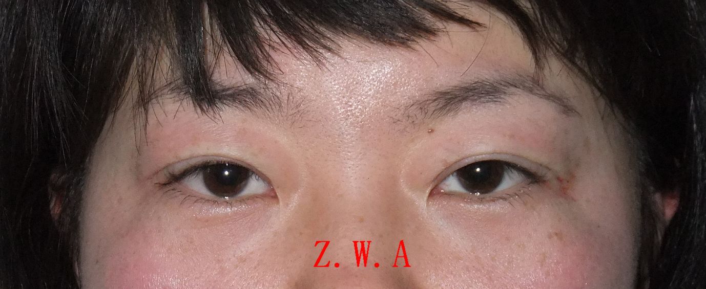 什么皮材质做钱包好_广州双眼皮需要多少钱_小孩双眼散光度及屈光度需要治疗吗