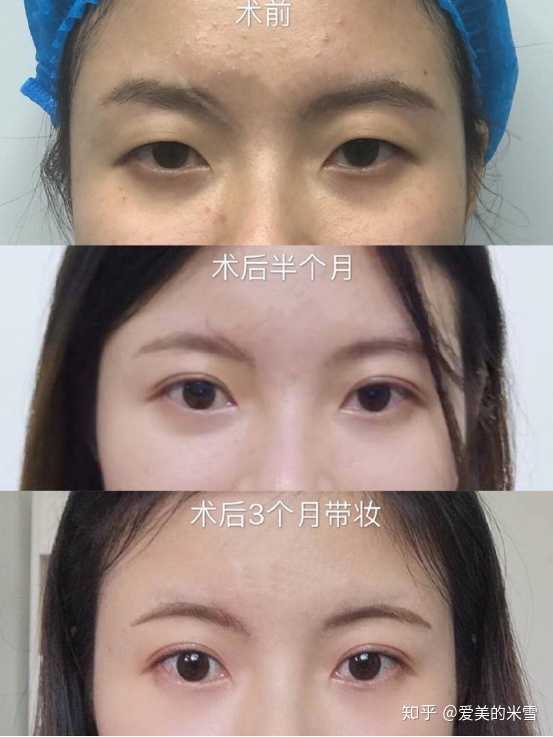 刘亦菲内双眼妆_内双眼妆教程_做的切割双眼皮跟内双呢怎么办