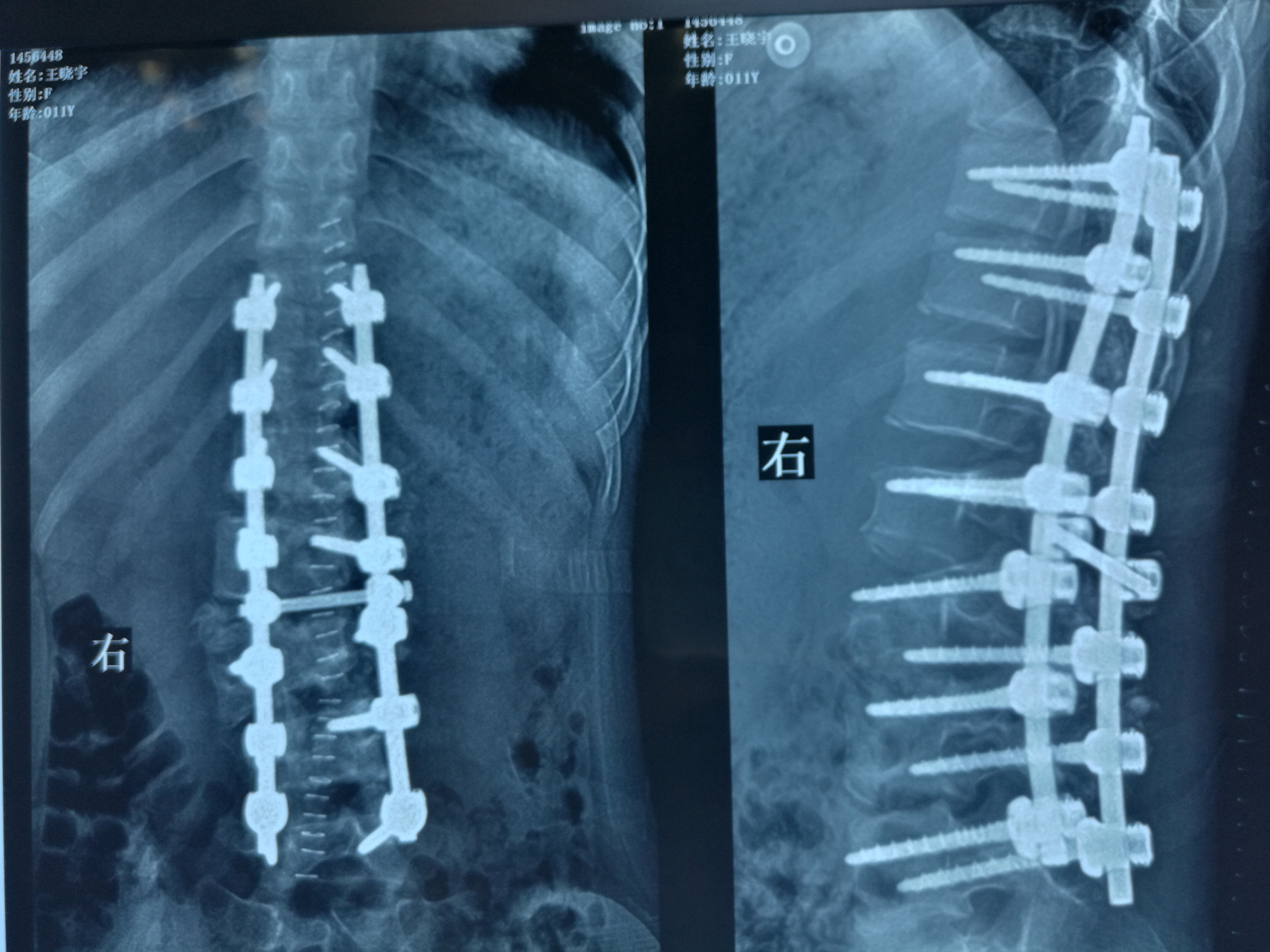 腰椎间盘突出吃中药要多久能好?_腰椎45突出要如何治疗_怎样治疗腰椎肩盘突出