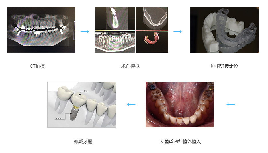做全口种植要多少钱_上海做全口种植牙要多少钱_做牙套的过程要多久