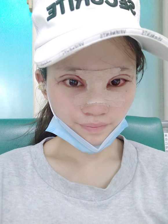 开双眼皮需要多少钱啊_上海开双眼皮的医院_南京开双眼皮的医院
