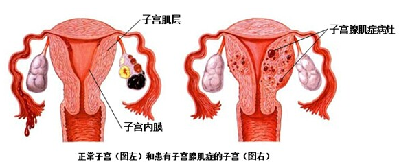 子宫水平偏后位是什么意思_子宫偏小吃什么能变大_始基子宫变幼稚子宫