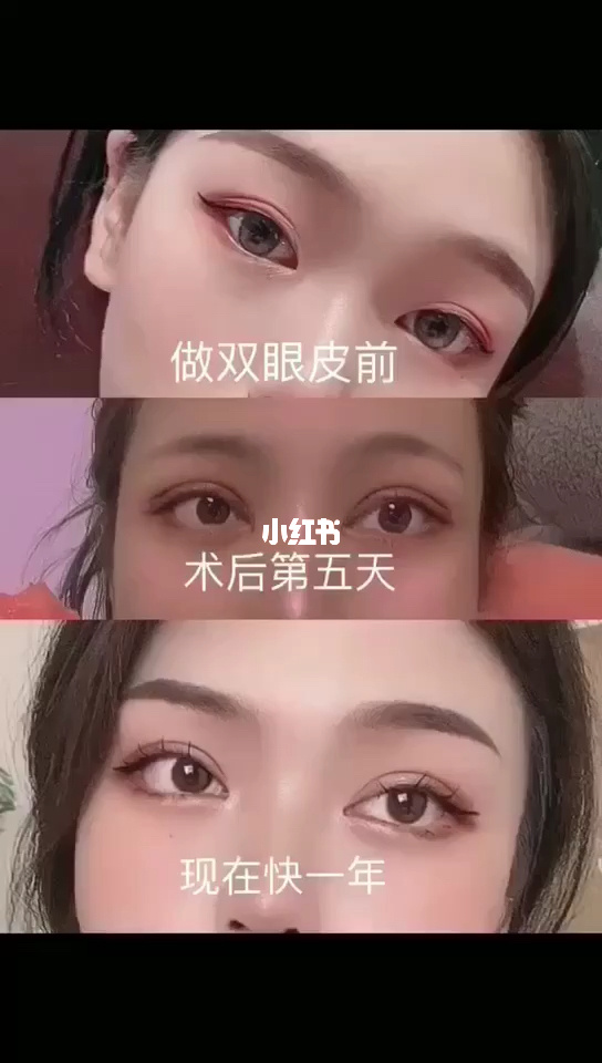 杭州哪个专家割双眼好_郑州羊癫疯专家速问康好_郑州做双眼皮最好专家