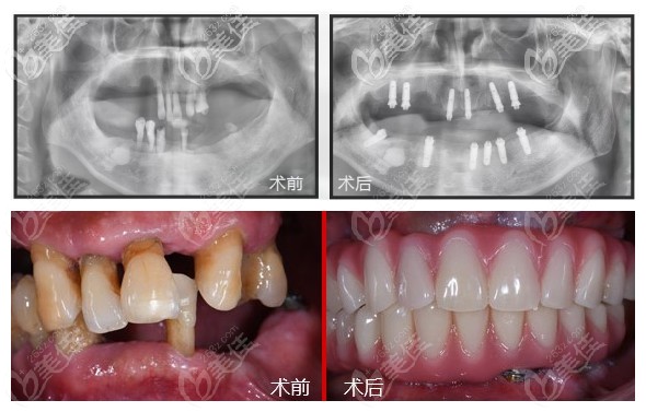 做牙贴片对自己牙齿有伤害么_种植牙有必要做贵的吗_上海做种植牙齿的价格
