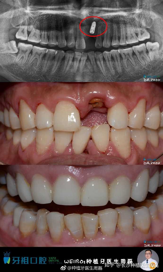 种植牙有必要做贵的吗_做牙贴片对自己牙齿有伤害么_上海做种植牙齿的价格