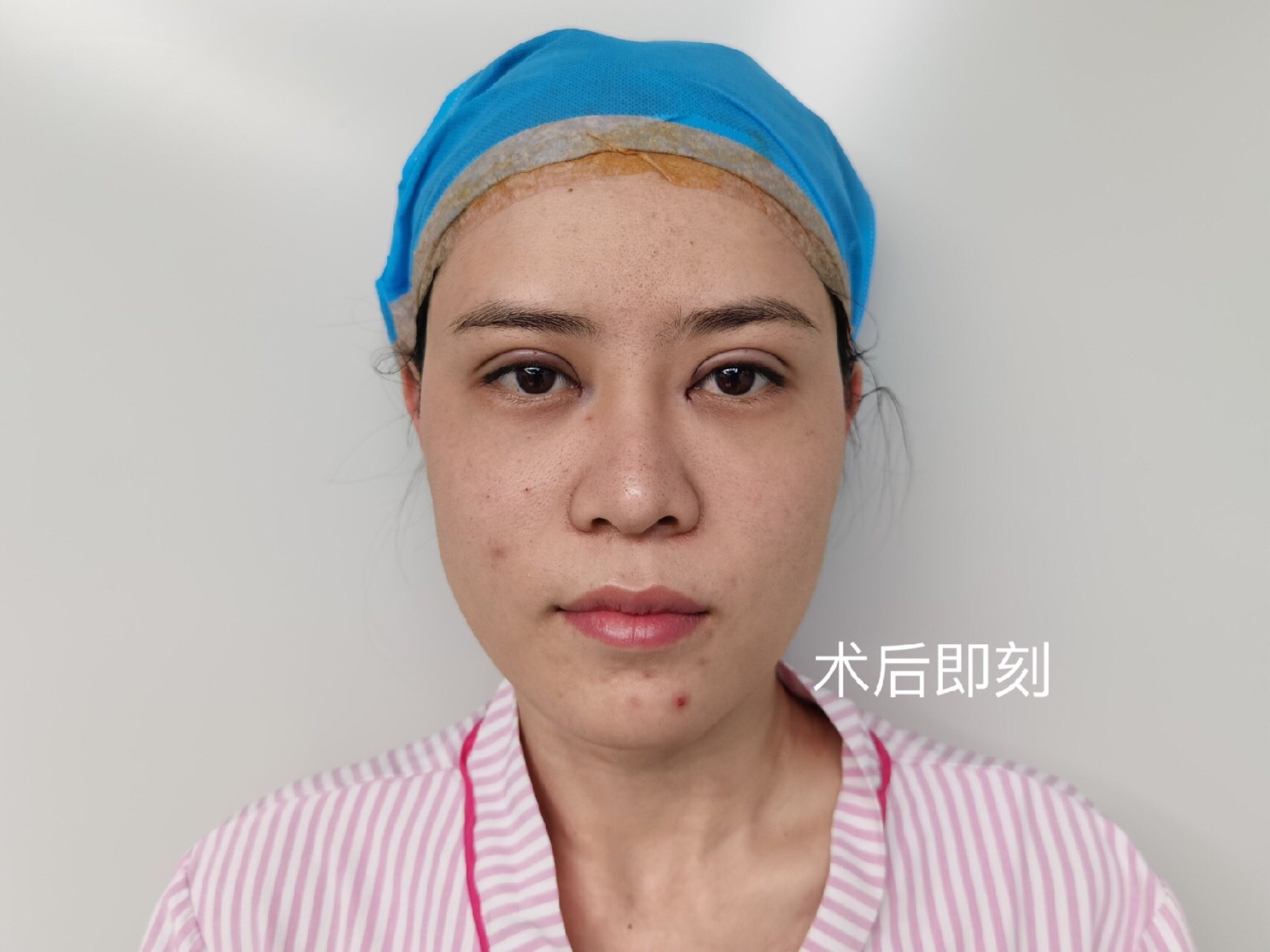 做双眼皮价格介绍_杭州整形做双眼皮的_才做双眼皮的十天照片