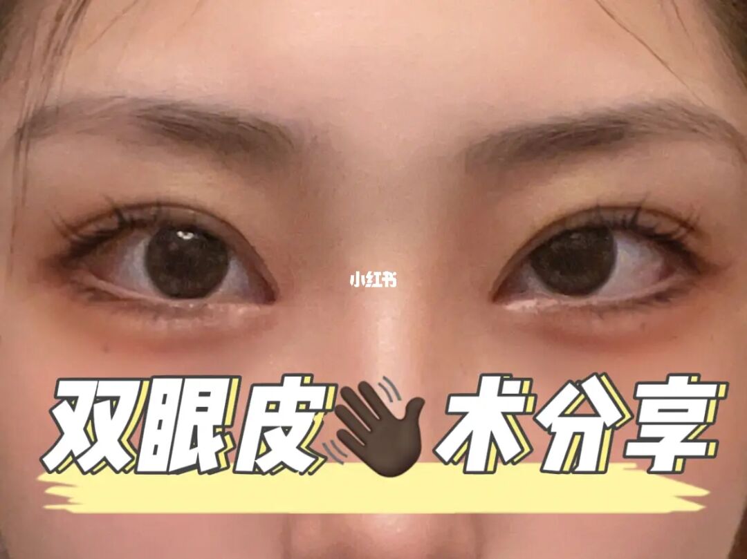 杭州整形做双眼皮的_做双眼皮价格介绍_才做双眼皮的十天照片