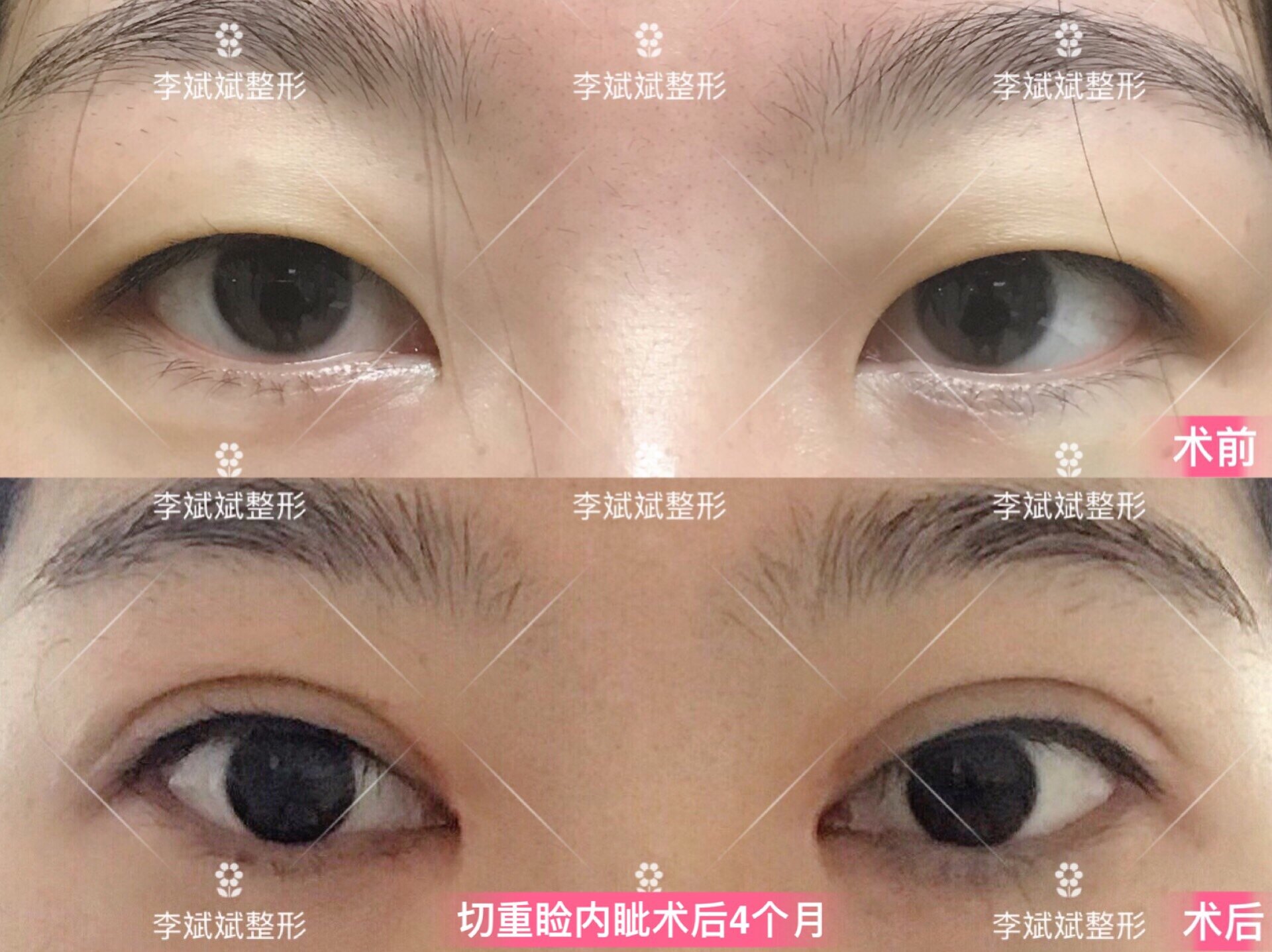 北京做双眼皮比较有名的医生_北京哪个三甲医院可以做皮秒_北京哪里做定点双眼皮比较好