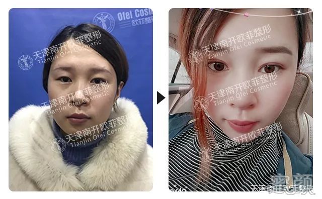 北京哪个三甲医院可以做皮秒_北京哪里做定点双眼皮比较好_北京做双眼皮比较有名的医生
