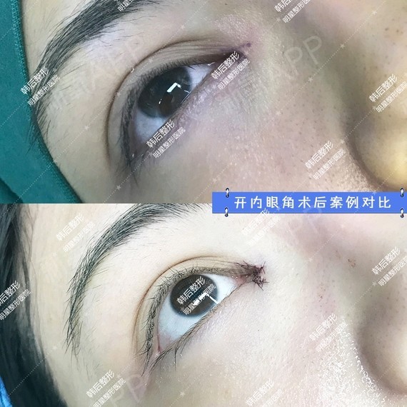 北京做双眼皮比较有名的医生_北京哪里做定点双眼皮比较好_北京哪个三甲医院可以做皮秒