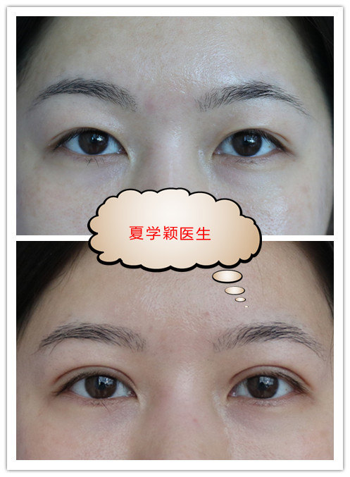 北京哪里做定点双眼皮比较好_北京割双眼哪个医院好_北京哪家医院做四维比较详细