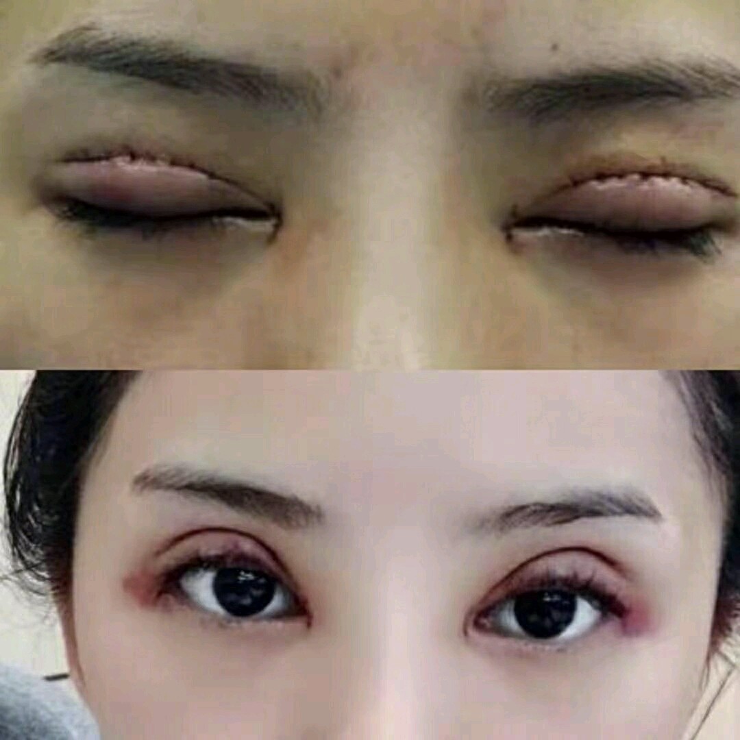 北京哪家医院做四维比较详细_北京哪里做定点双眼皮比较好_北京割双眼哪个医院好