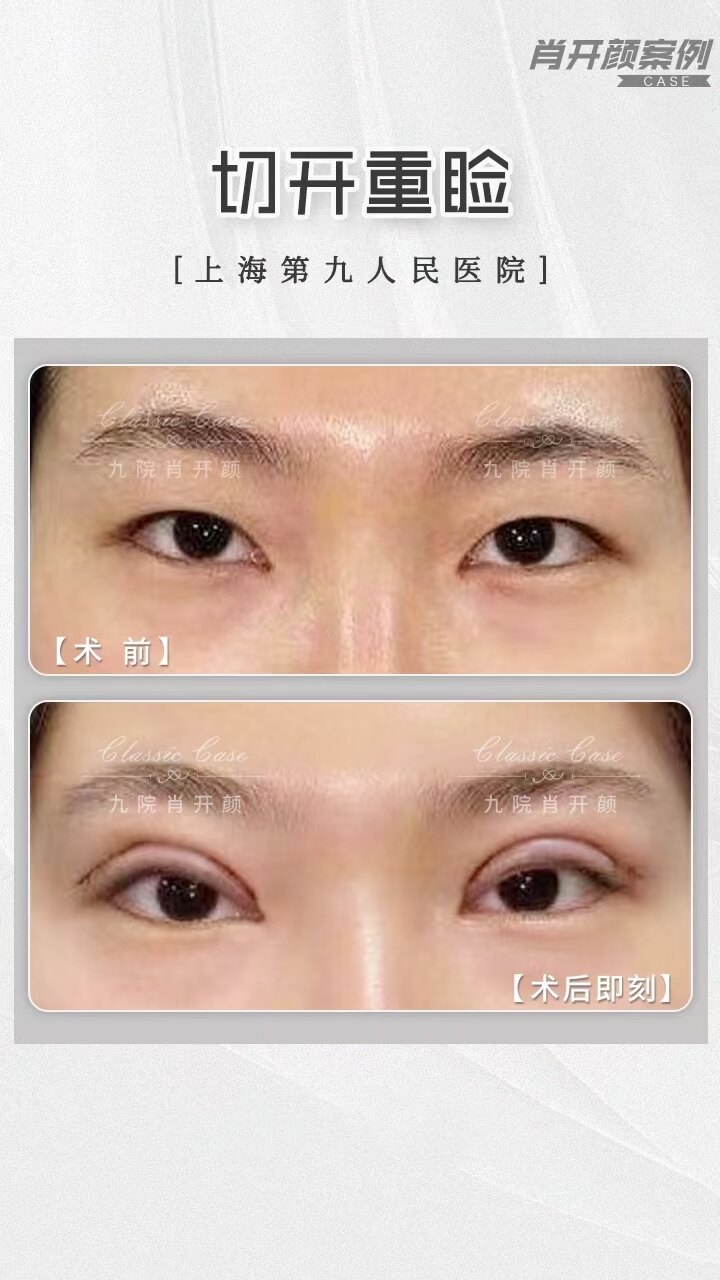 扁皮弹弓瞄准定位截图_双眼皮三点定位费用_韩式3点和5点定位区别