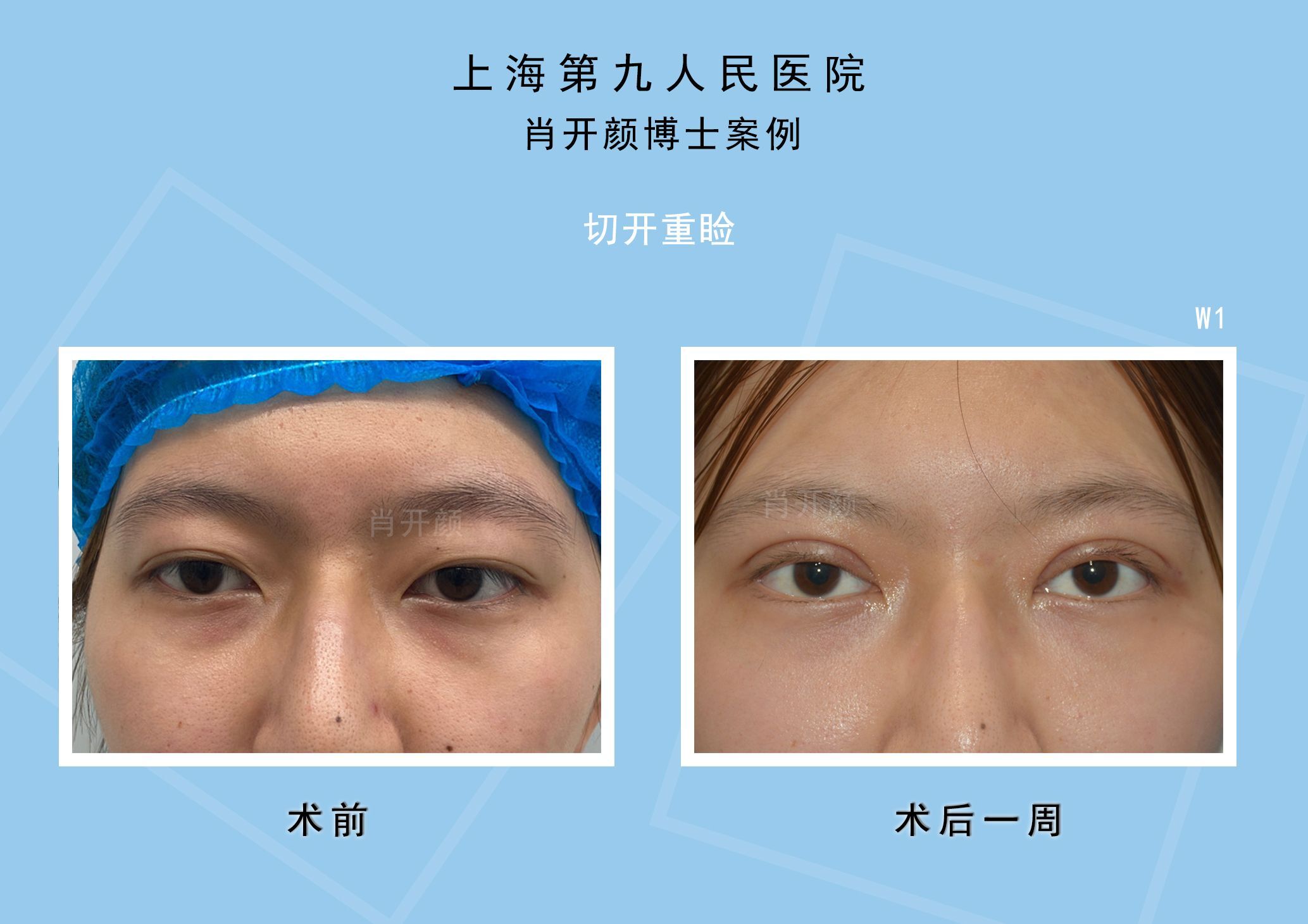 双眼皮三点定位费用_扁皮弹弓瞄准定位截图_韩式3点和5点定位区别