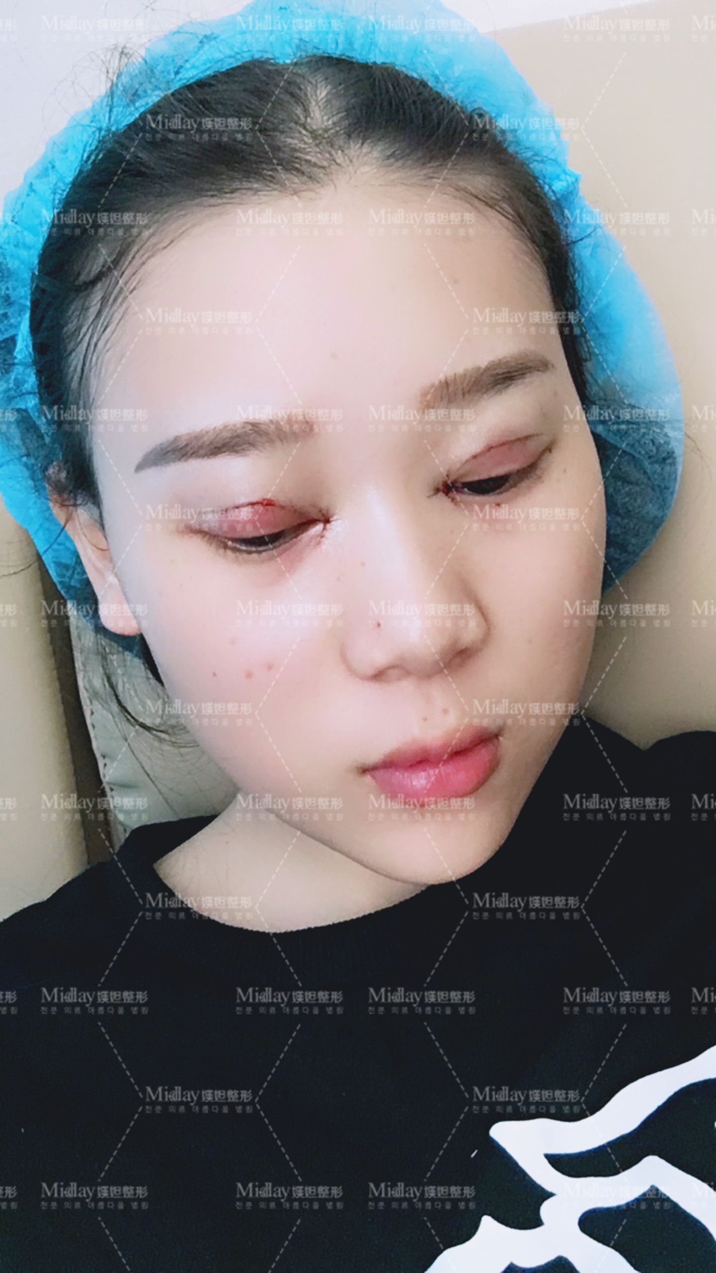 韩式3点和5点定位区别_双眼皮三点定位费用_扁皮弹弓瞄准定位截图