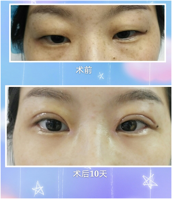 扁皮弹弓瞄准定位截图_双眼皮三点定位费用_韩式3点和5点定位区别