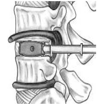 脊柱侧弯断棒有多疼_脊柱打麻药后脊柱疼_脊柱中间一节疼以及对应的前胸也疼
