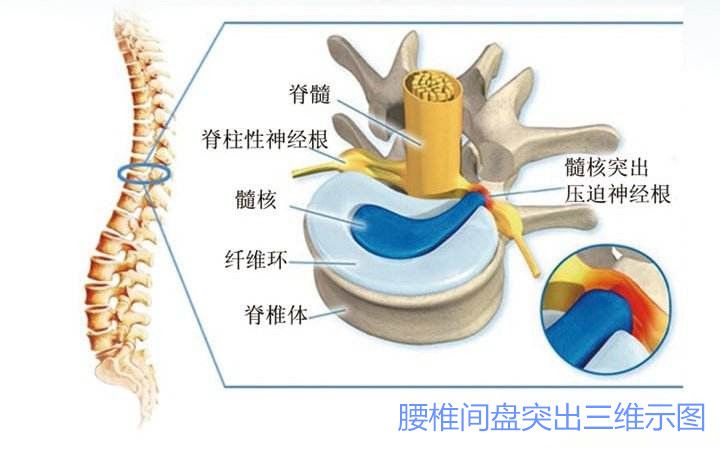 颈椎间盘突出的锻炼_颈椎盘突出早期症状_深圳治疗颈椎盘突出