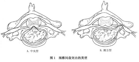 腰椎间盘突出的锻炼_中央台腰椎肩盘突出治疗仪_腰椎突出锻炼方法图片