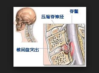 中央台腰椎肩盘突出治疗仪_腰椎间盘突出的锻炼_腰椎突出锻炼方法图片