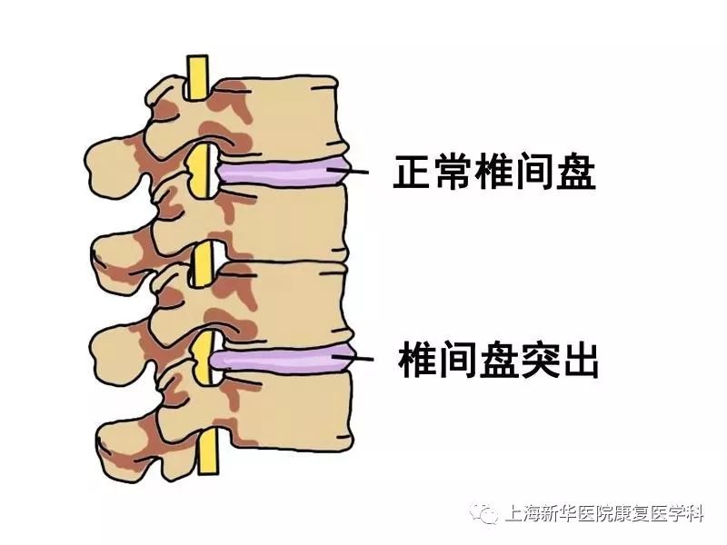 腰椎突出锻炼方法图片_中央台腰椎肩盘突出治疗仪_腰椎间盘突出的锻炼