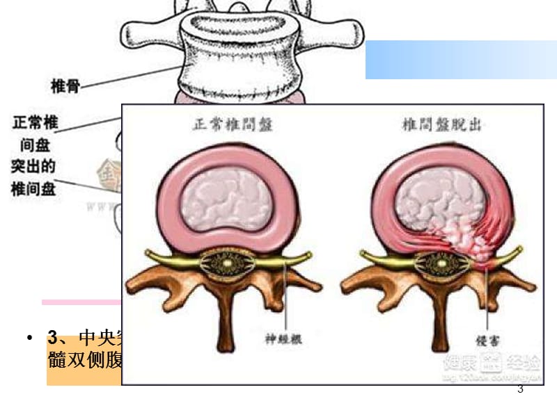 腰椎突出锻炼方法图片_腰椎间盘突出的锻炼_中央台腰椎肩盘突出治疗仪