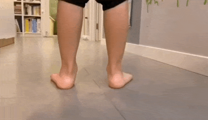 宝宝走路外八字腿视频_内八字腿走路是怎样的_内八字腿怎么矫正图解