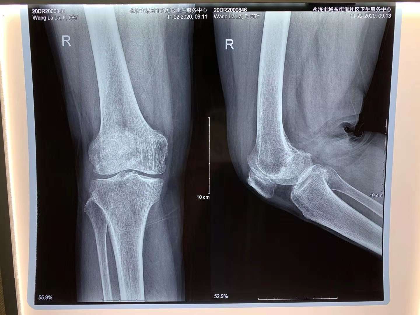 膝盖片子正常图图片