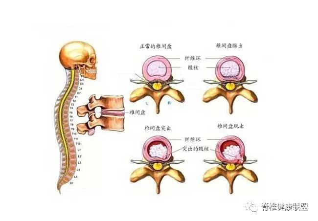 腰椎肩盘突出症_腰椎间盘突出的锻炼_腰椎突出怎么锻炼腰背肌肉