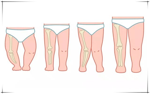 怎样矫正x腿型_盘腿坐能矫正x型腿吗_x腿型矫正带